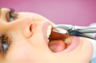 Сложное удаление зуба 