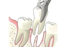 Удаление зуба по острой боли
