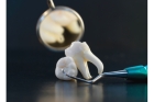 Удаление корней зуба