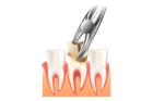 Удаление фрагмента зуба