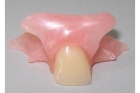 Протезирование одного зуба