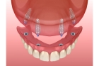 Протезирование зубов верхней челюсти
