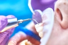 Профессиональная гигиеническая чистка зубов