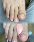 Коррекция вросшего ногтя без воспаления