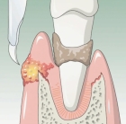 Удаление экзостоза в области 1 зуба