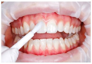 Покрытие зуба (фторирование) 1 зуб