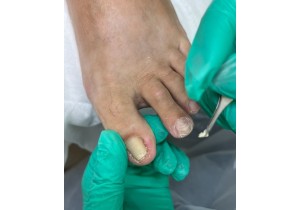 Коррекция вросшего ногтя воспаленного